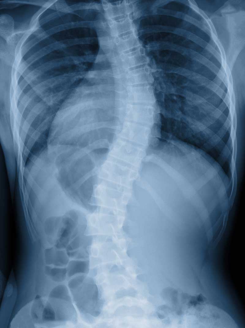 Scoliosis Simi Valley, CA